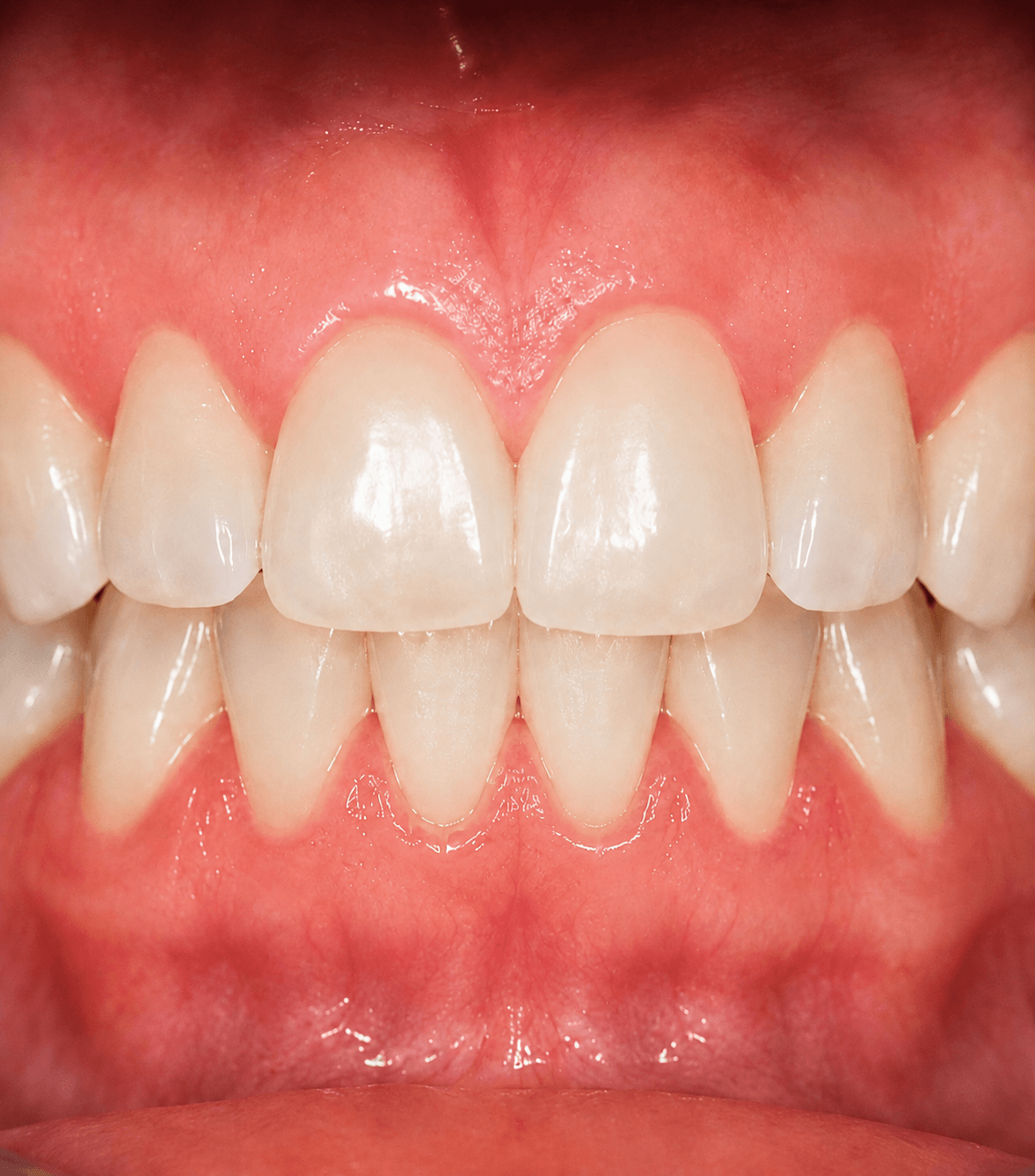 Healthy Gums