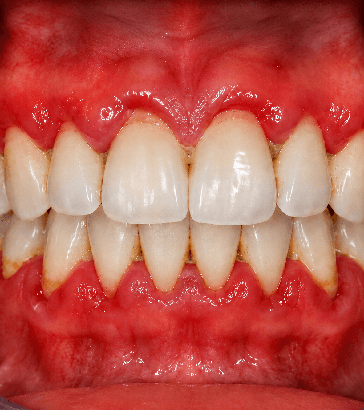 Inflamed Gums